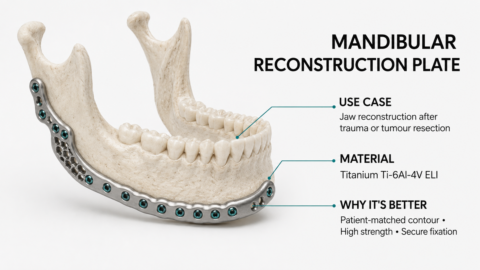 Mandibular Reconstruction Plate — Jaw reconstruction after trauma or tumour resection in Titanium Ti-6Al-4V ELI